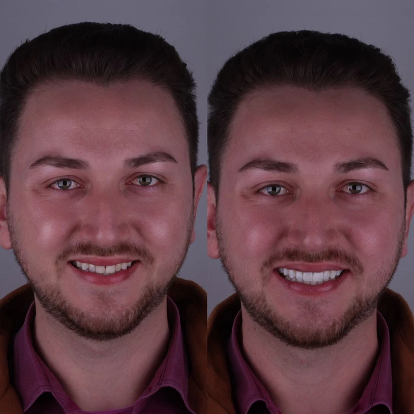 Antes-e-depois-4-Mariliaa